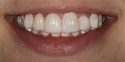 Before & After Photos | Golden Rule Dental | Smile Gallery | Knoxville TN