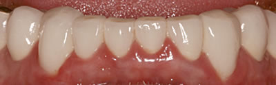 Dental Crowns After