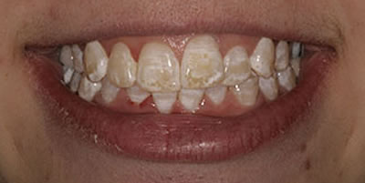 Composite Veneers Before