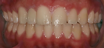 Knoxville Dental Implants After