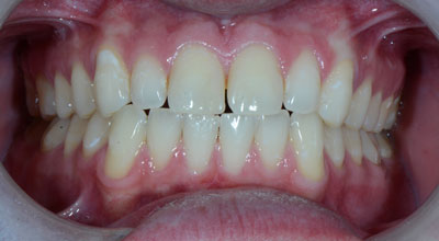 Cosmetic Dentist Before Photo