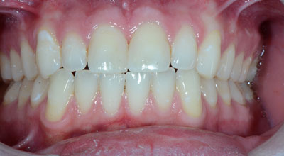 Porcelain Veneer Treatment Knoxville TN - Repair Broken Tooth